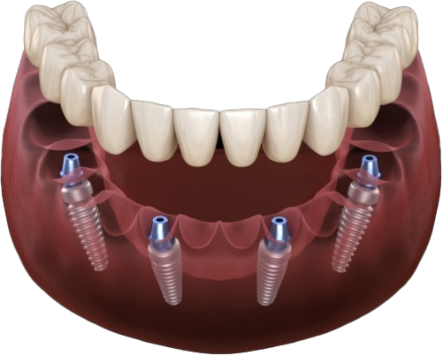 implant